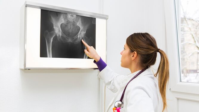 La gran mayoría de las fracturas de cadera se producen a partir de los 50 años.