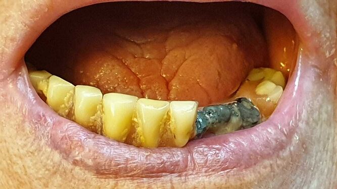 Aspecto que llegó a tener la boca de la paciente tras colocarse las prótesis.