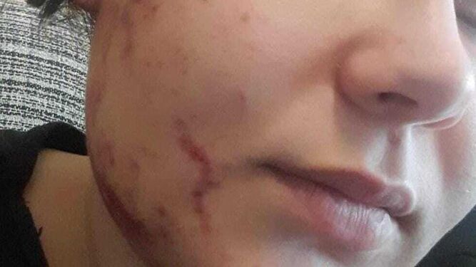 Lesiones aún visibles en la cara de la joven agredida en Jerez.