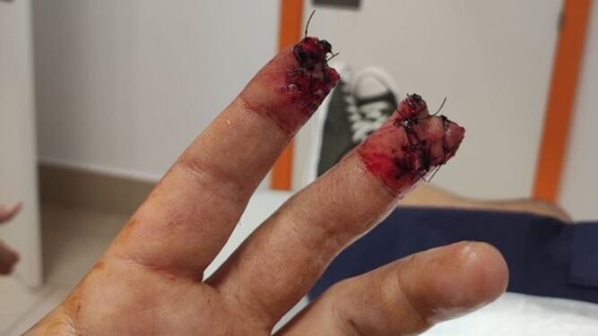 Falanges de dos dedos amputadas tras el accidente que sufrió Jesús Rafael